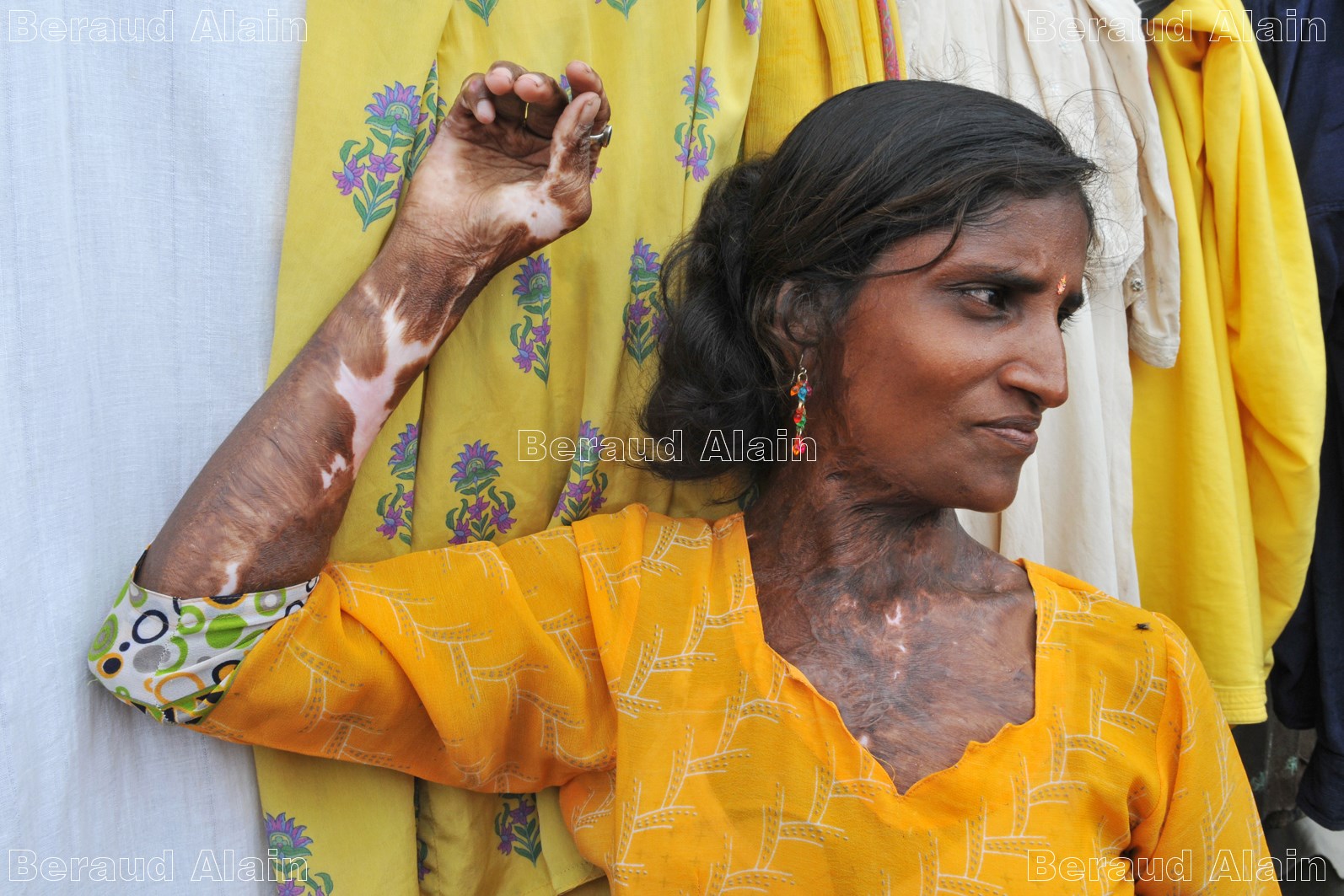 13 Bandra Femme vitriolée par son mari